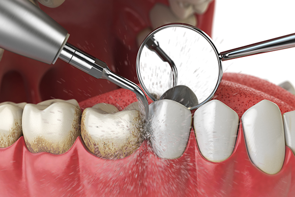 歯の歯石除去